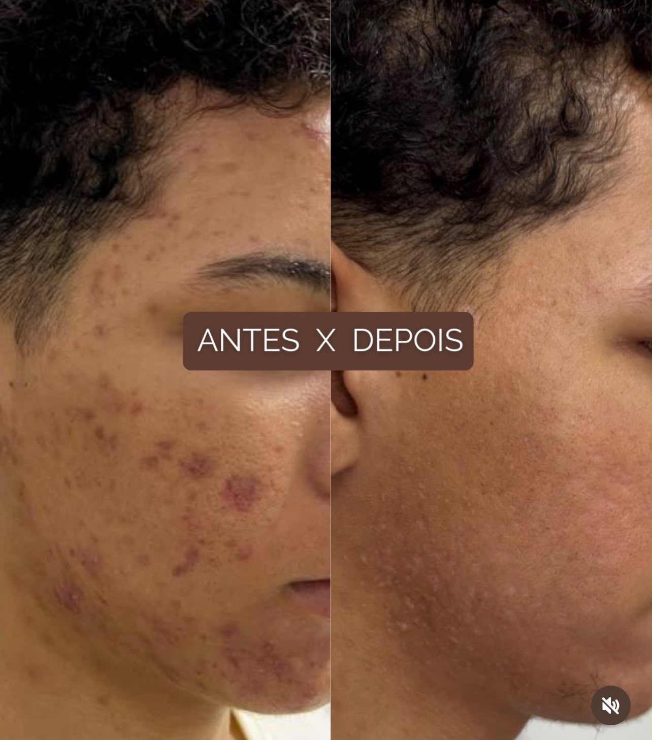 Controle de acne e melhora da textura da pele