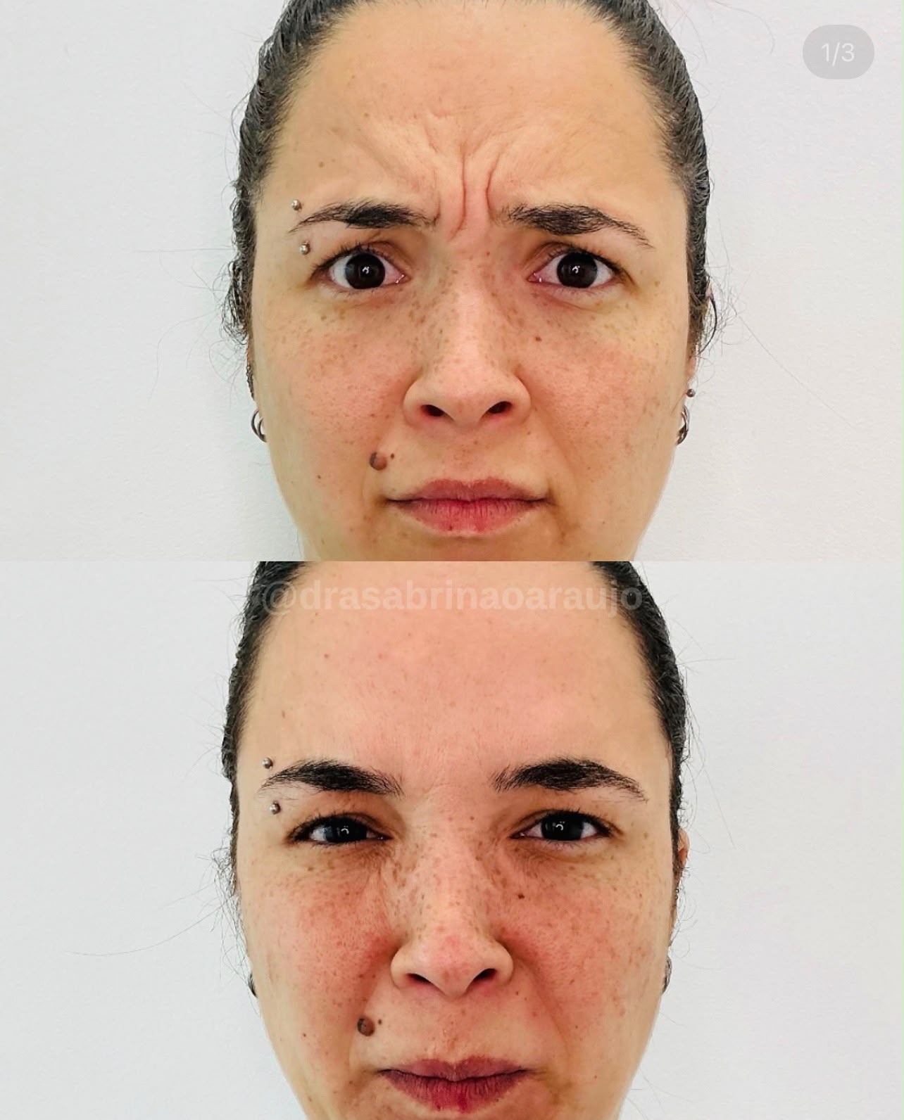 Tratamento de rugas na glabela — antes e depois